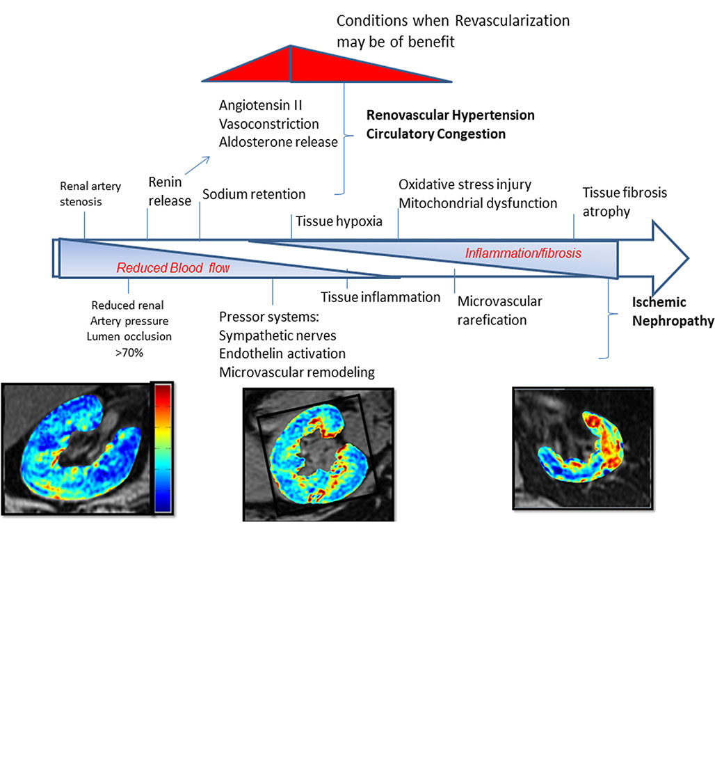 Revascularization for Renovascular Disease: A Scientific Statement From the American Heart Association